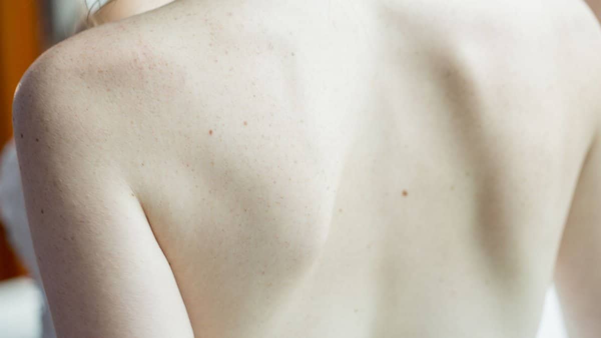 A detailed close-up image of a woman's back, highlighting skin texture and subtle freckles.